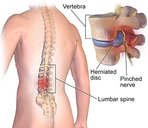 Lower Back Pain, Lumbar Strain  Jacksonville Orthopedic Surgeon