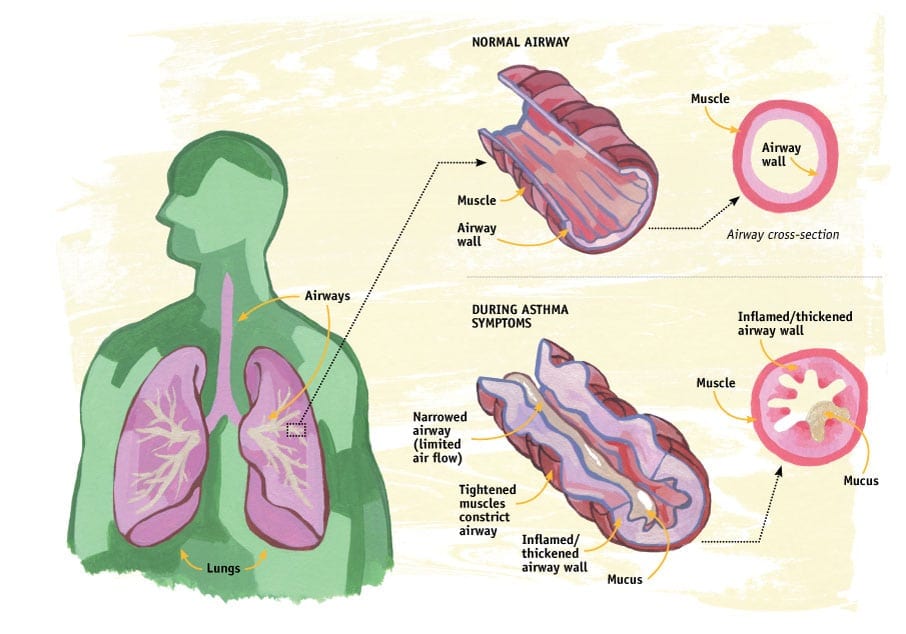 Asthma: A closer look