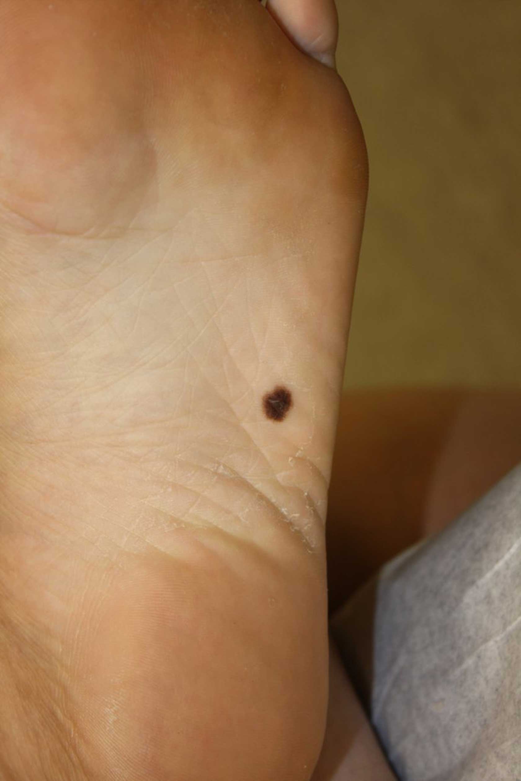 red-spots-on-feet-causes-how-to-treat-them-emedihealth